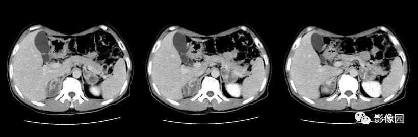 【病例】肾上腺结核1例CT影像表现 【病例】肾上腺结核1例CT影像表现