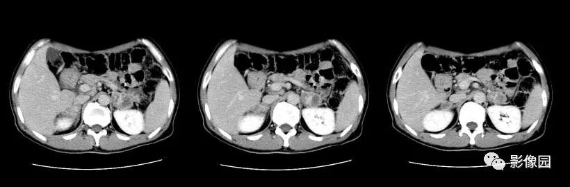 【病例】肾上腺结核1例CT影像表现 【病例】肾上腺结核1例CT影像表现