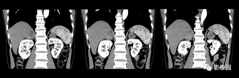 【病例】肾上腺结核1例CT影像表现 【病例】肾上腺结核1例CT影像表现