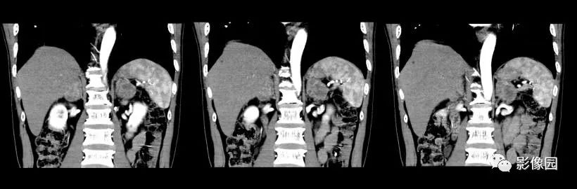 【病例】肾上腺结核1例CT影像表现 【病例】肾上腺结核1例CT影像表现