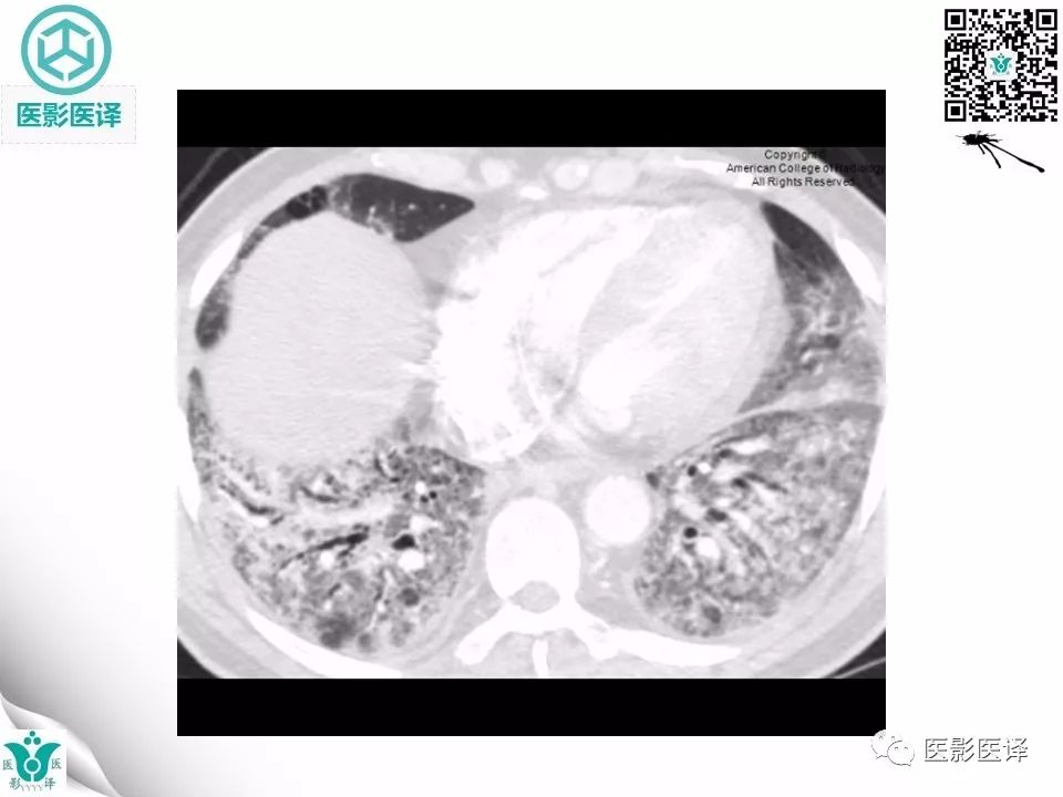 【病例】非特异性间质性肺炎NSIP一例X线CT