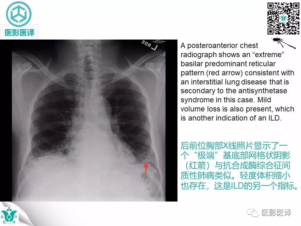 【病例】非特异性间质性肺炎NSIP一例X线CT