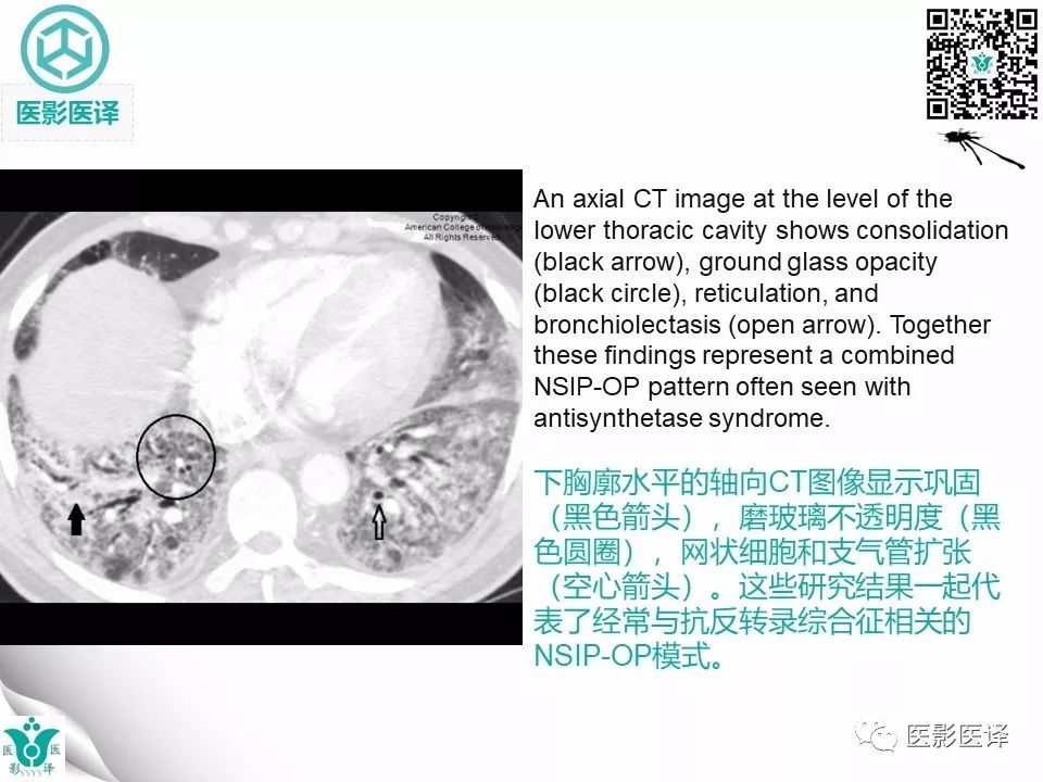 【病例】非特异性间质性肺炎NSIP一例X线CT