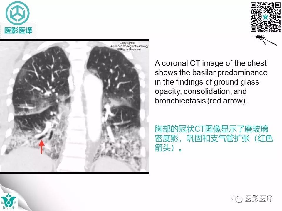 【病例】非特异性间质性肺炎NSIP一例X线CT