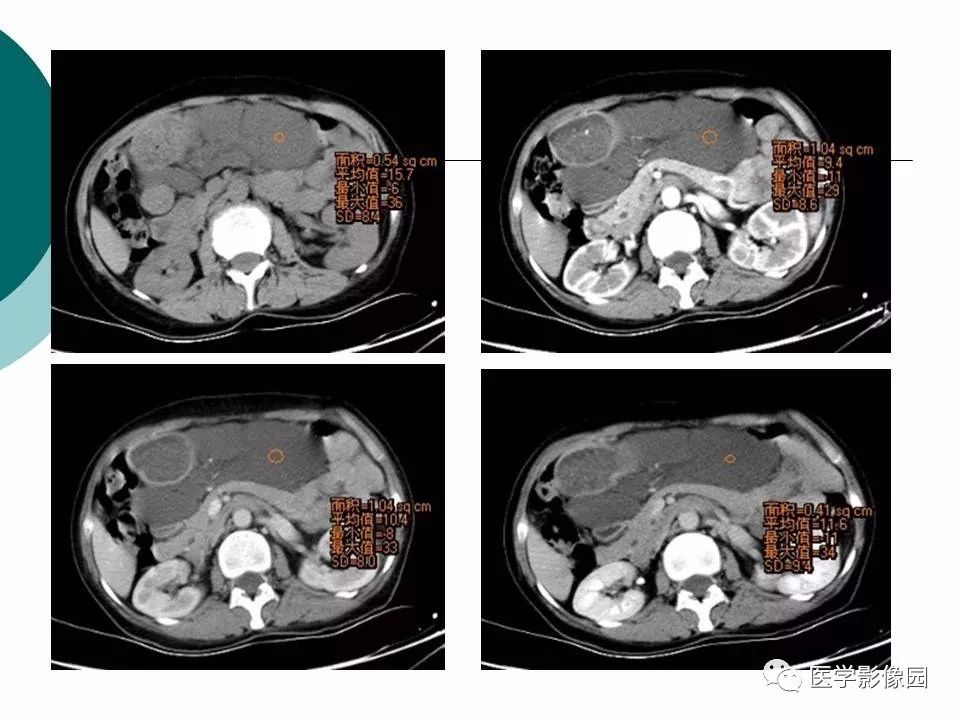 【病例】腹腔淋巴管瘤1例CT影像表现