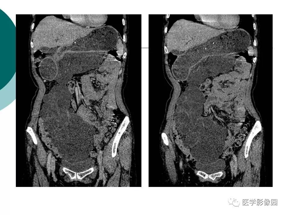 【病例】腹腔淋巴管瘤1例CT影像表现