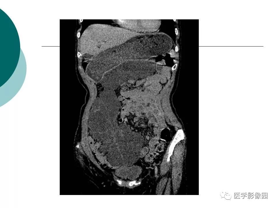 【病例】腹腔淋巴管瘤1例CT影像表现