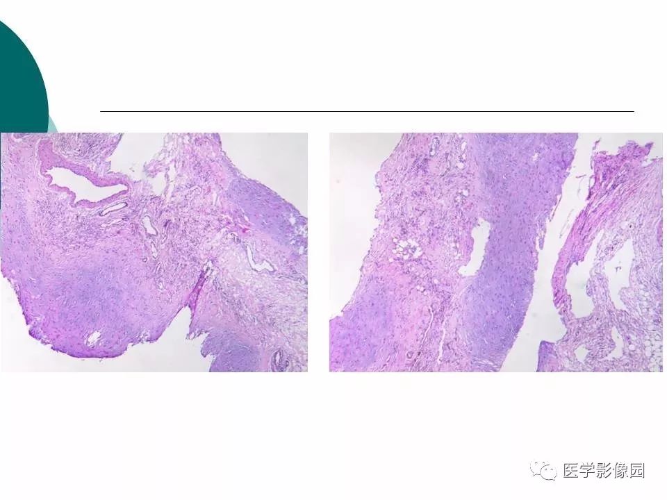 【病例】腹腔淋巴管瘤1例CT影像表现