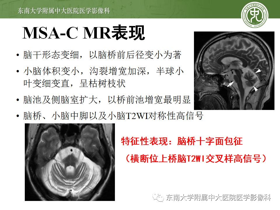 【病例】多系统萎缩1例MR影像诊断
