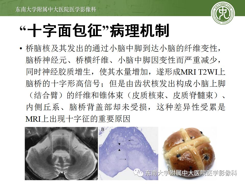 【病例】多系统萎缩1例MR影像诊断