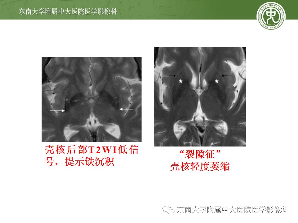 【病例】多系统萎缩1例MR影像诊断