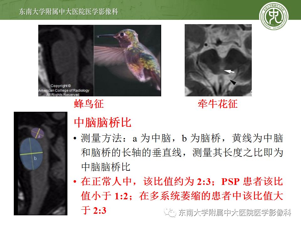 【病例】多系统萎缩1例MR影像诊断