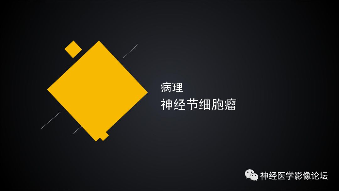 【病例】鞍区神经节细胞瘤一例CT及MR