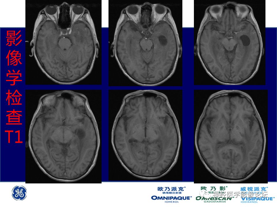 【病例】颅内隐球菌感染一例MR影像表现