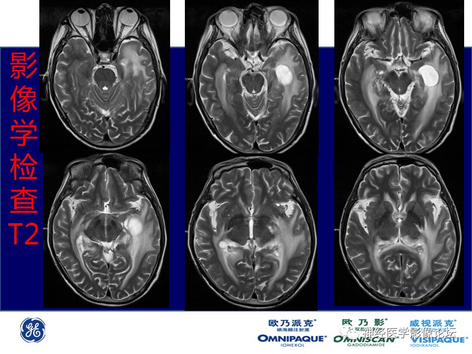 【病例】颅内隐球菌感染一例MR影像表现