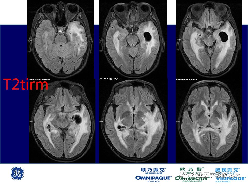 【病例】颅内隐球菌感染一例MR影像表现