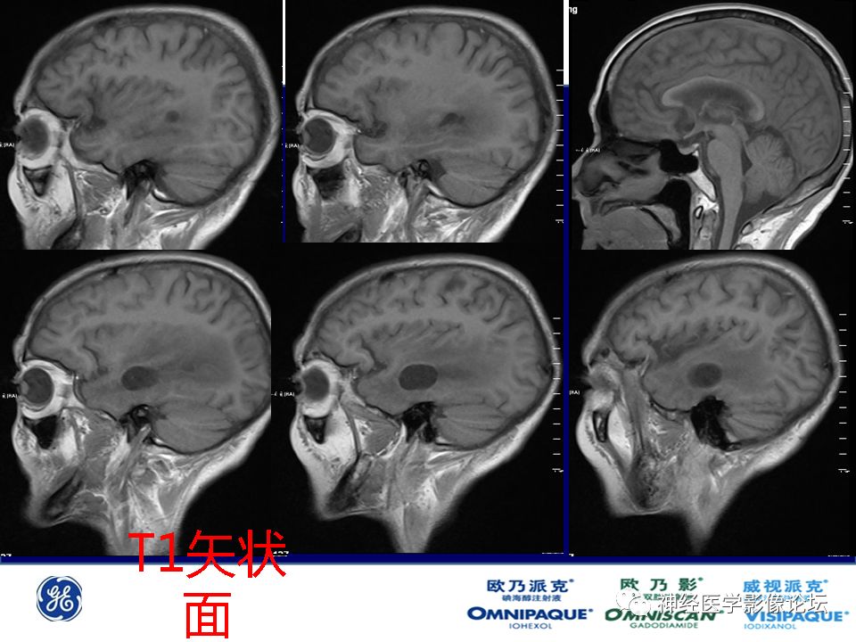 【病例】颅内隐球菌感染一例MR影像表现