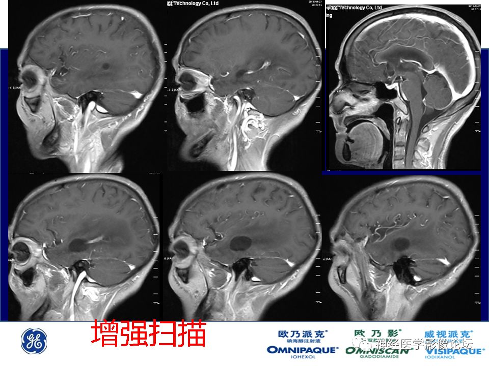 【病例】颅内隐球菌感染一例MR影像表现