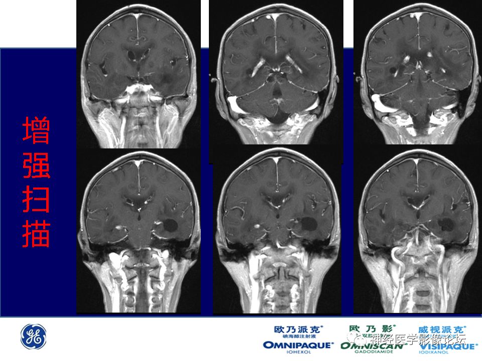 【病例】颅内隐球菌感染一例MR影像表现