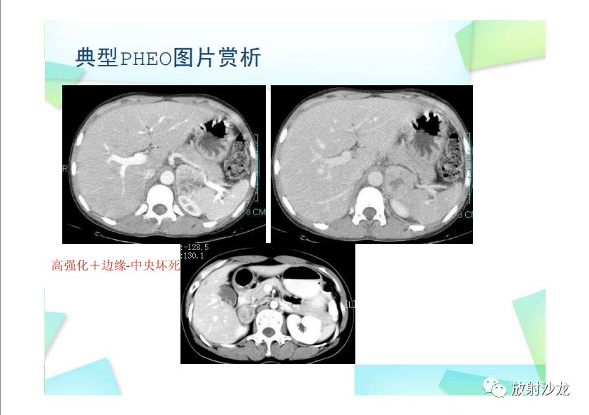 【PPT】肾上腺嗜铬细胞瘤与肾上腺皮质癌的鉴别诊断