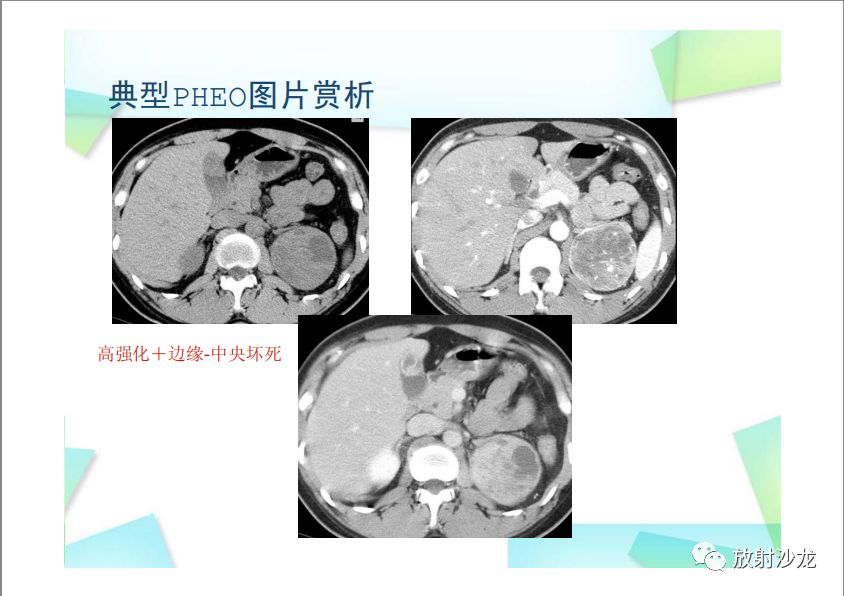 【PPT】肾上腺嗜铬细胞瘤与肾上腺皮质癌的鉴别诊断