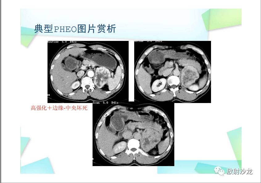 【PPT】肾上腺嗜铬细胞瘤与肾上腺皮质癌的鉴别诊断