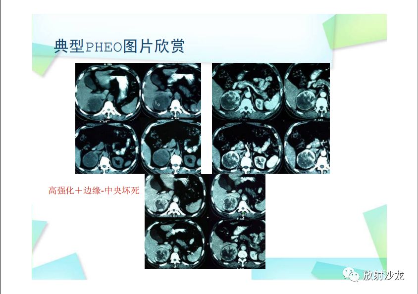 【PPT】肾上腺嗜铬细胞瘤与肾上腺皮质癌的鉴别诊断