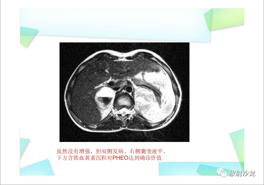 【PPT】肾上腺嗜铬细胞瘤与肾上腺皮质癌的鉴别诊断
