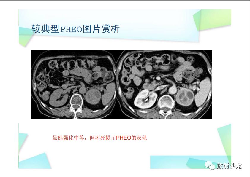 【PPT】肾上腺嗜铬细胞瘤与肾上腺皮质癌的鉴别诊断