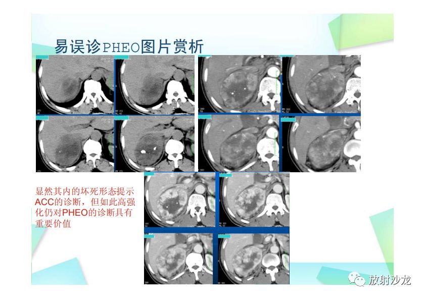【PPT】肾上腺嗜铬细胞瘤与肾上腺皮质癌的鉴别诊断