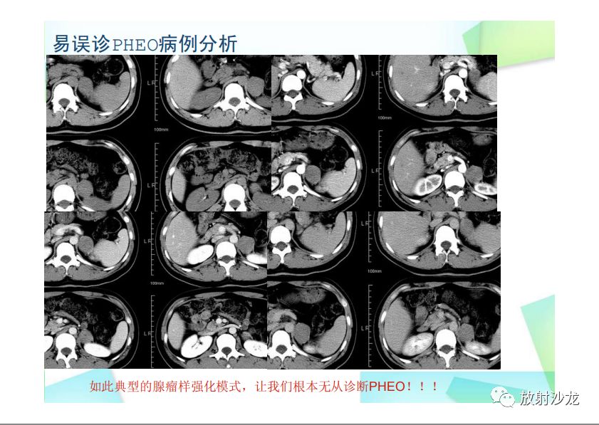 【PPT】肾上腺嗜铬细胞瘤与肾上腺皮质癌的鉴别诊断