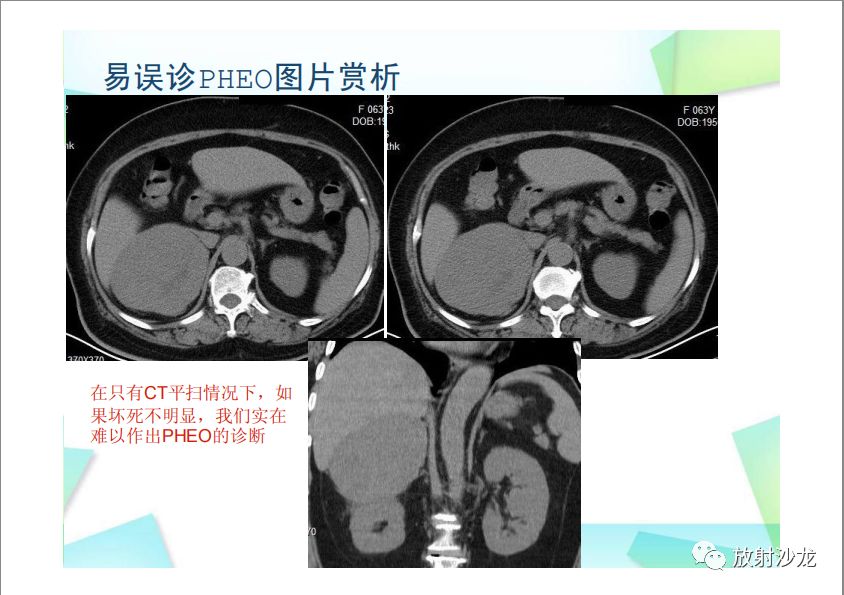【PPT】肾上腺嗜铬细胞瘤与肾上腺皮质癌的鉴别诊断