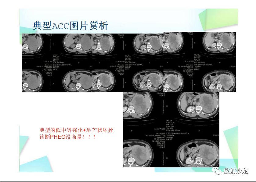 【PPT】肾上腺嗜铬细胞瘤与肾上腺皮质癌的鉴别诊断