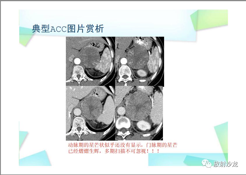 【PPT】肾上腺嗜铬细胞瘤与肾上腺皮质癌的鉴别诊断