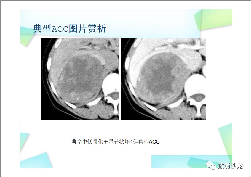【PPT】肾上腺嗜铬细胞瘤与肾上腺皮质癌的鉴别诊断