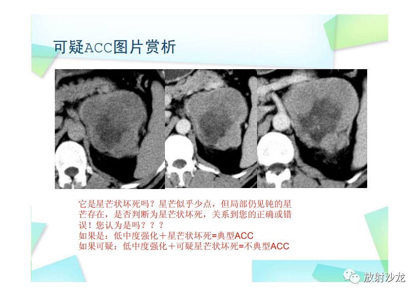 【PPT】肾上腺嗜铬细胞瘤与肾上腺皮质癌的鉴别诊断