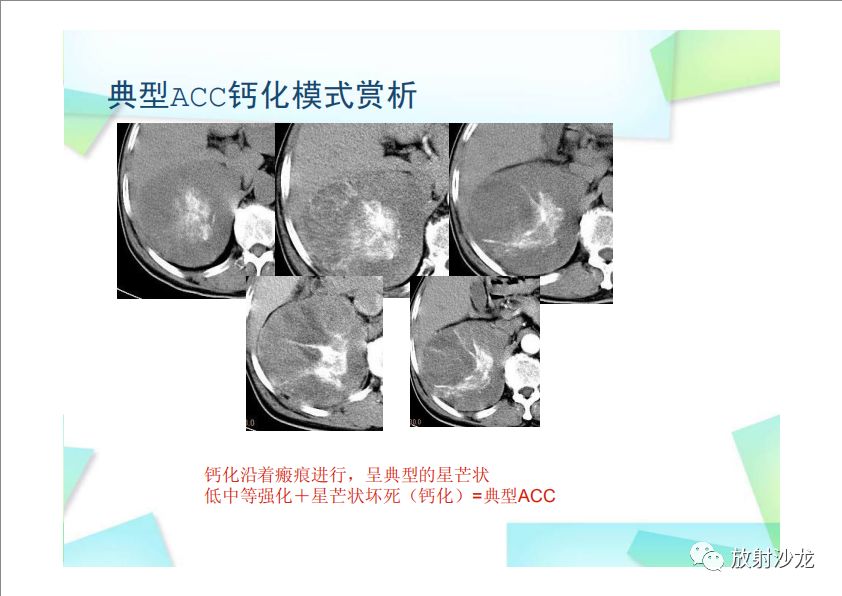 【PPT】肾上腺嗜铬细胞瘤与肾上腺皮质癌的鉴别诊断
