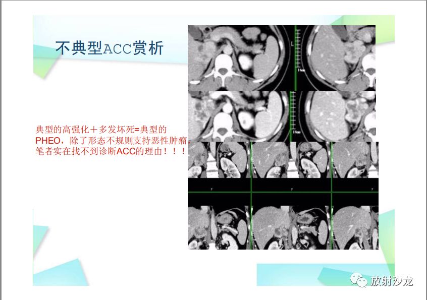 【PPT】肾上腺嗜铬细胞瘤与肾上腺皮质癌的鉴别诊断