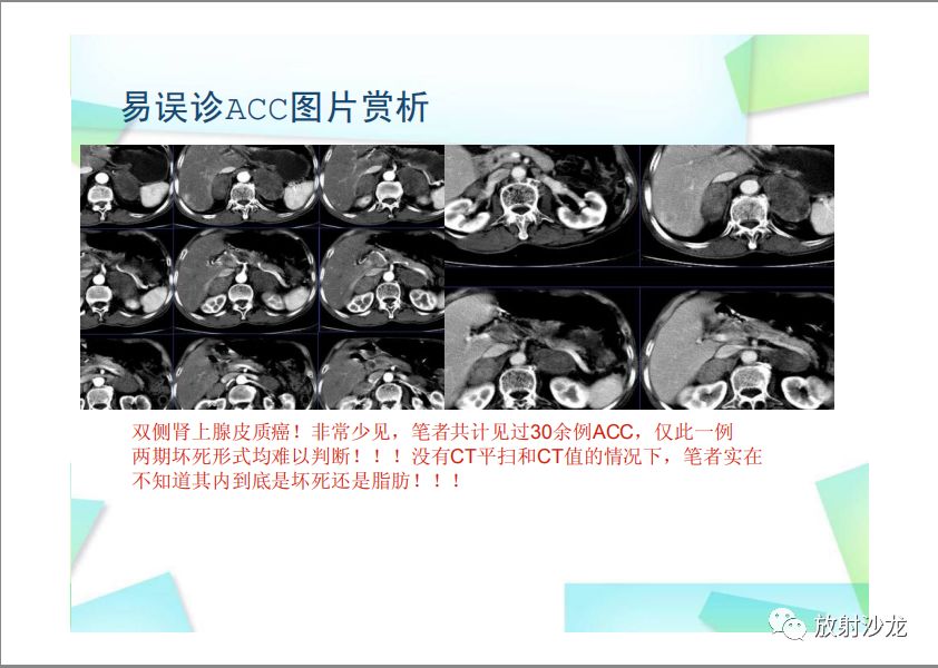 【PPT】肾上腺嗜铬细胞瘤与肾上腺皮质癌的鉴别诊断