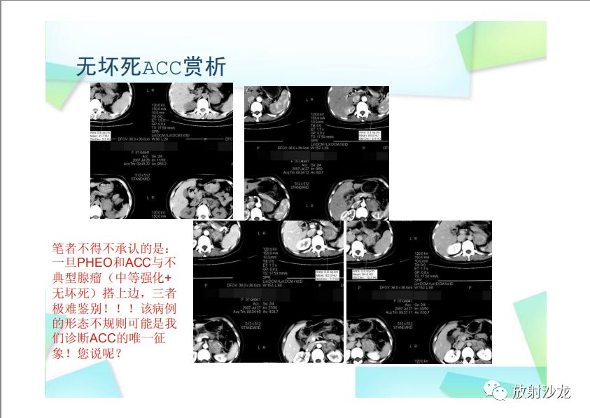 【PPT】肾上腺嗜铬细胞瘤与肾上腺皮质癌的鉴别诊断