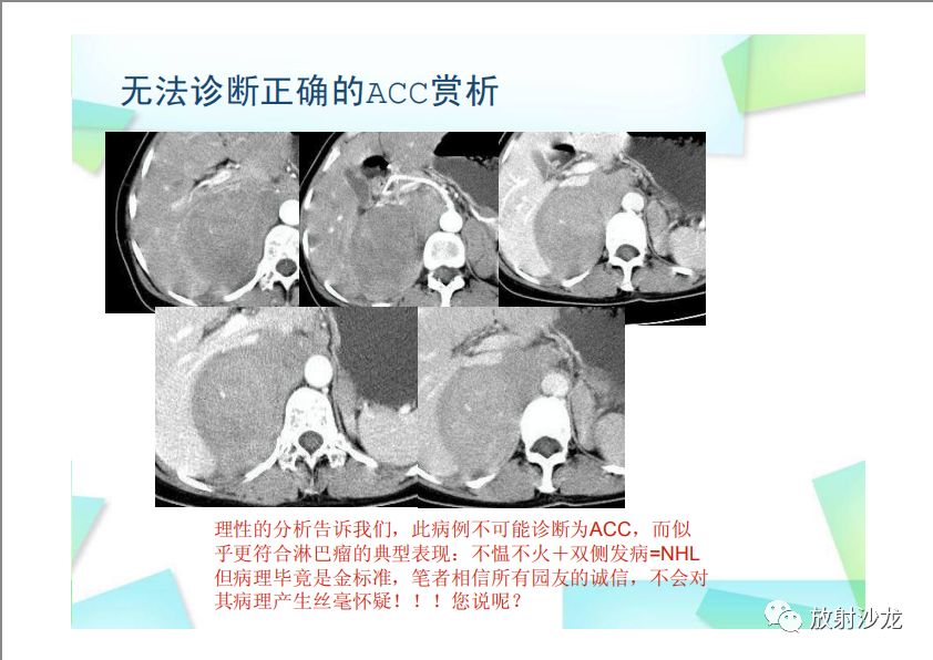 【PPT】肾上腺嗜铬细胞瘤与肾上腺皮质癌的鉴别诊断