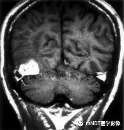 脑膜尾征=脑膜瘤?NO! 脑膜尾征=脑膜瘤?NO!