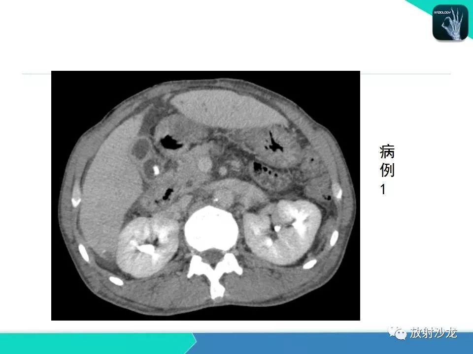 【PPT】肝吸虫性胆管炎的影像诊断