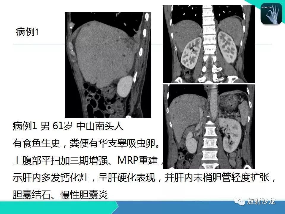 【PPT】肝吸虫性胆管炎的影像诊断