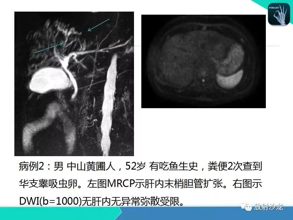 【PPT】肝吸虫性胆管炎的影像诊断