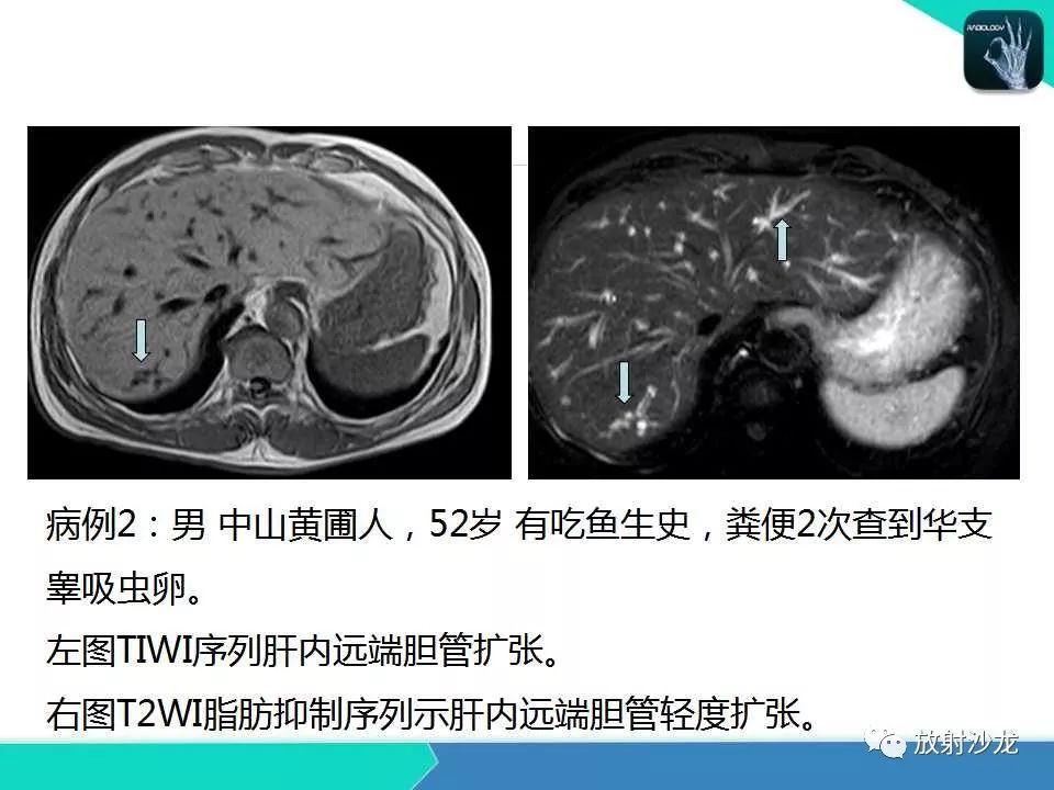 【PPT】肝吸虫性胆管炎的影像诊断