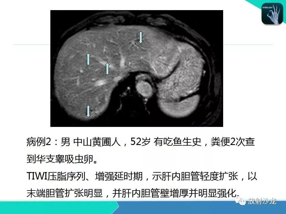 【PPT】肝吸虫性胆管炎的影像诊断