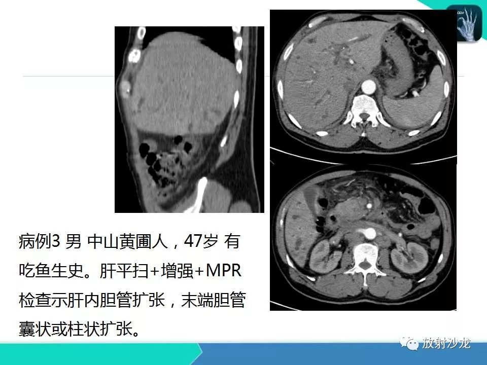 【PPT】肝吸虫性胆管炎的影像诊断