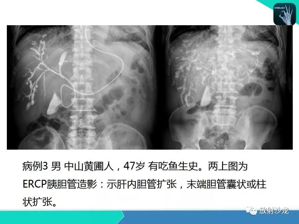 【PPT】肝吸虫性胆管炎的影像诊断