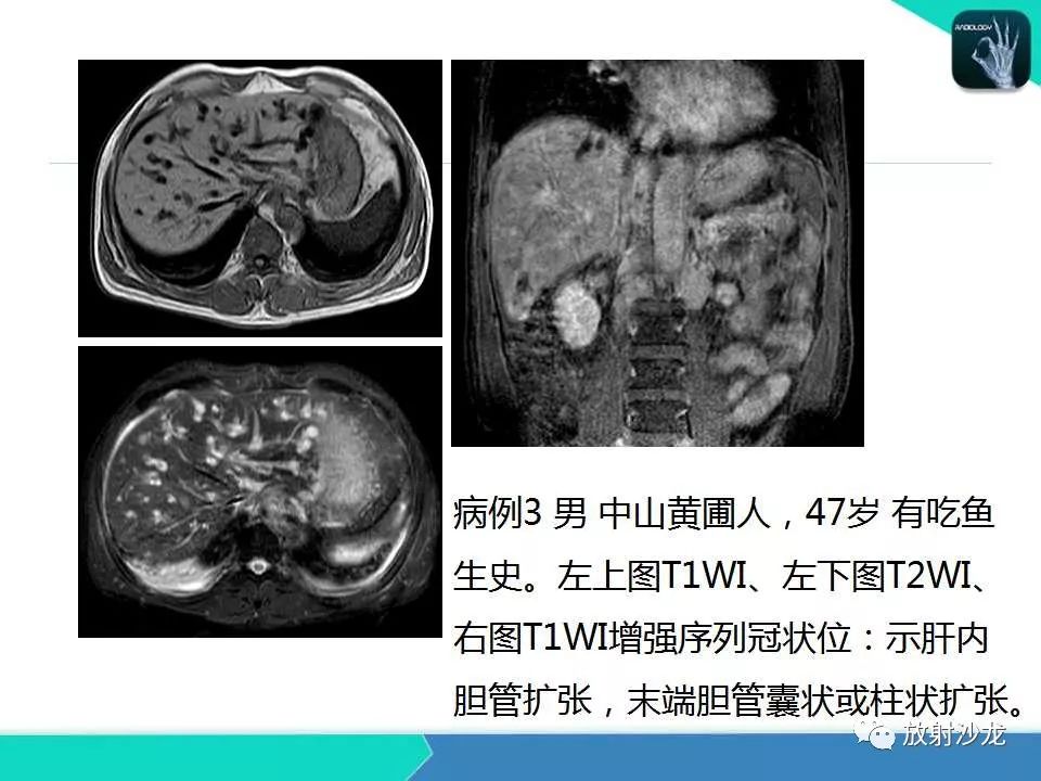 【PPT】肝吸虫性胆管炎的影像诊断